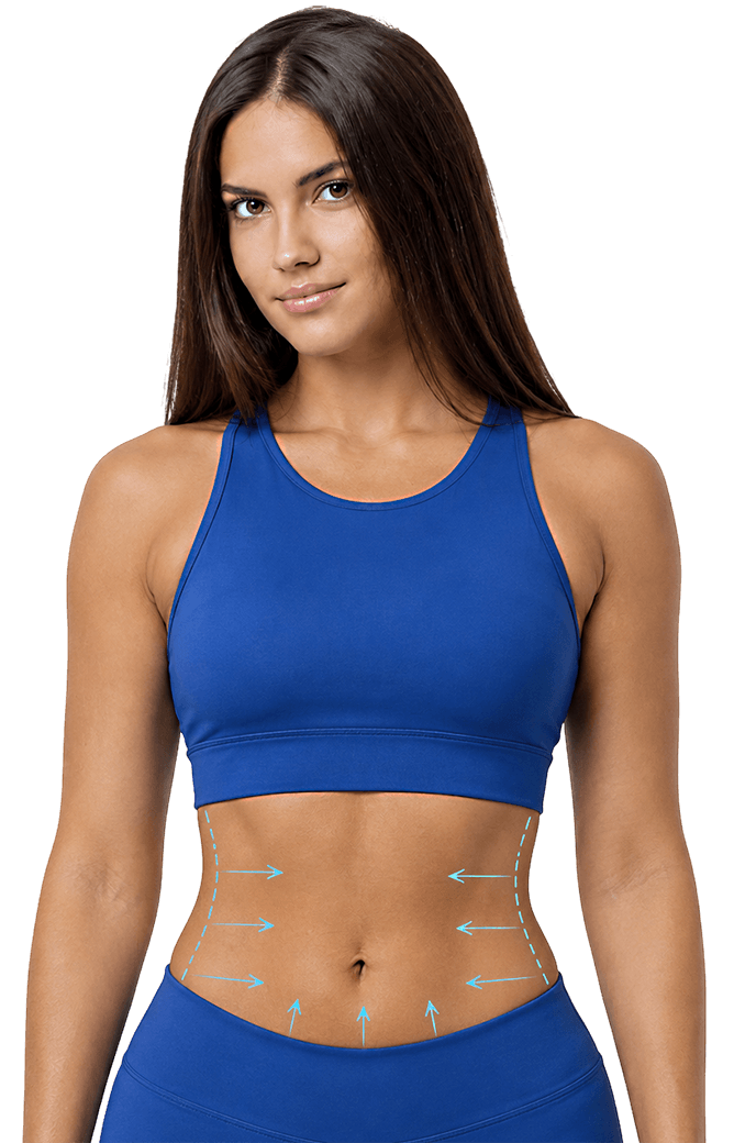 Abdominoplastia